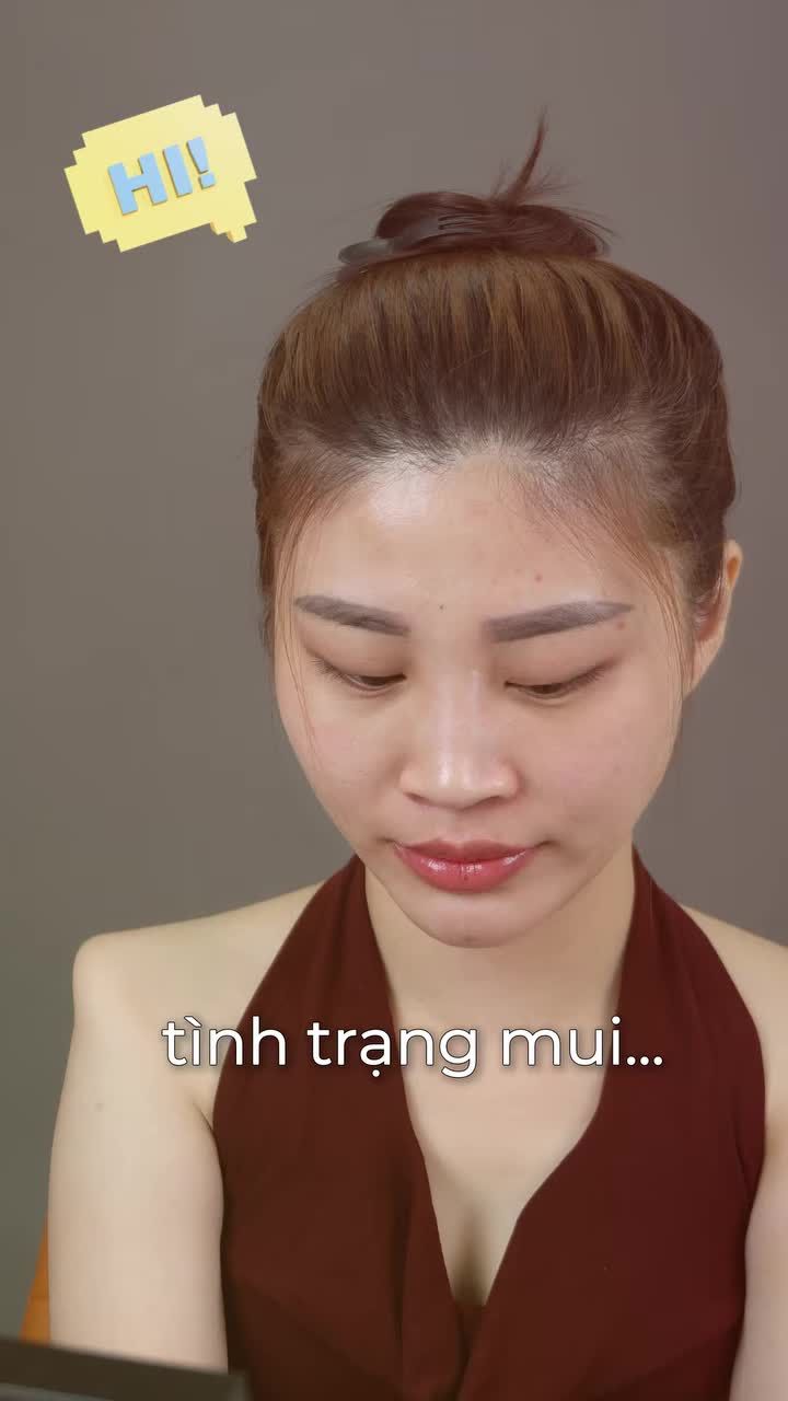 Mũi tiêm filler bị tràn, bè và mất form đã được cải thiện hoàn toàn sau 90 phút và lên form đẹp xuất sắc sau 10 ngày.