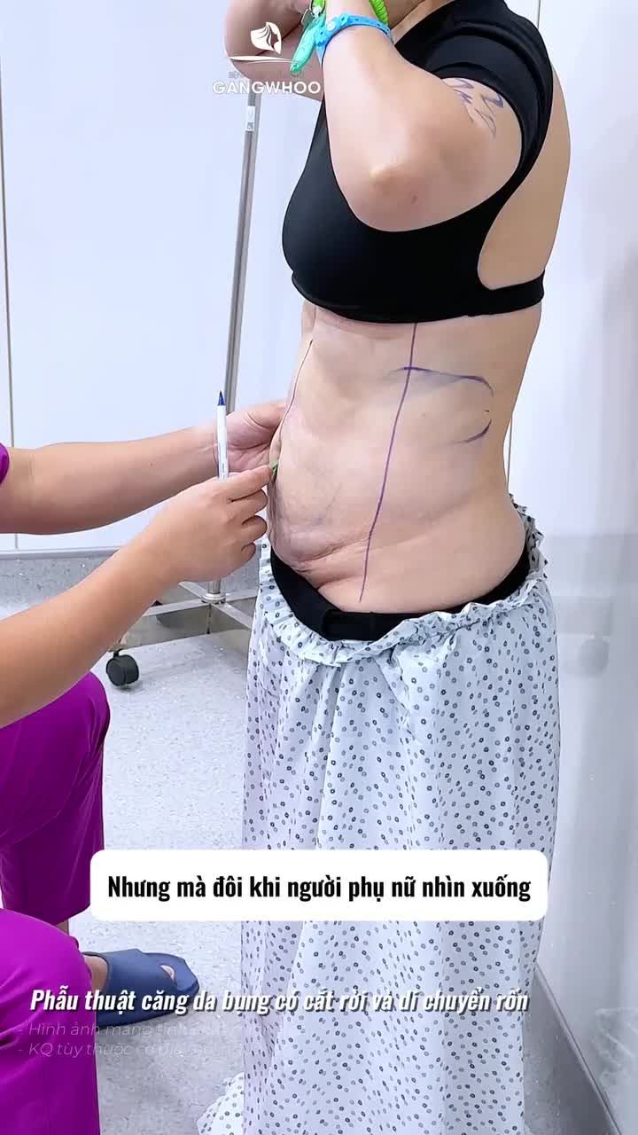 Vì muốn được đẹp hơn trong mắt chồng mình chị khách đã đến BVTM Gangwhoo phẫu thuật căng da bụng có cắt rời và di chuyển rốn.
