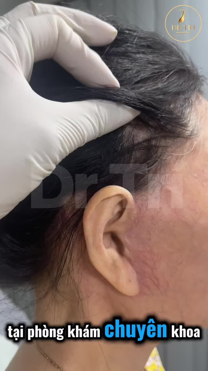 Kết quả sau 3 tháng chị khách sử dụng dịch vụ căng da Vline tại Tiến Sĩ Trí :