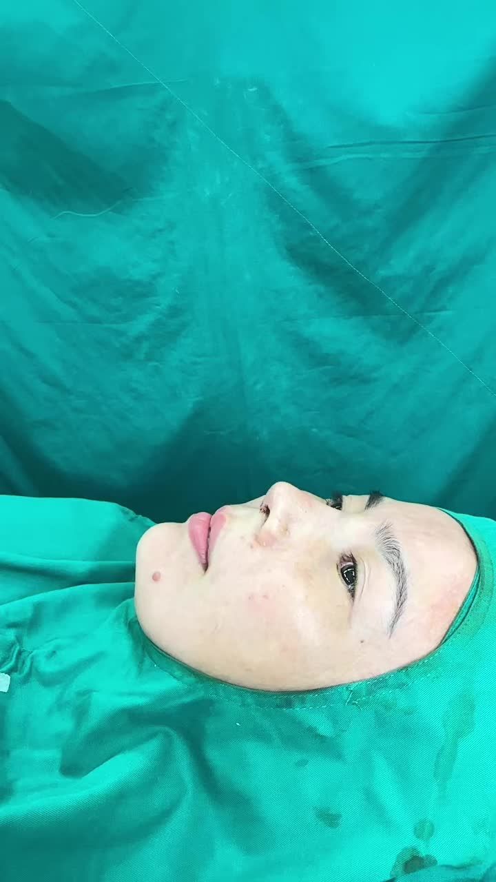 Mũi cấu trúc sửa lại surgiform vừa hoàn thành