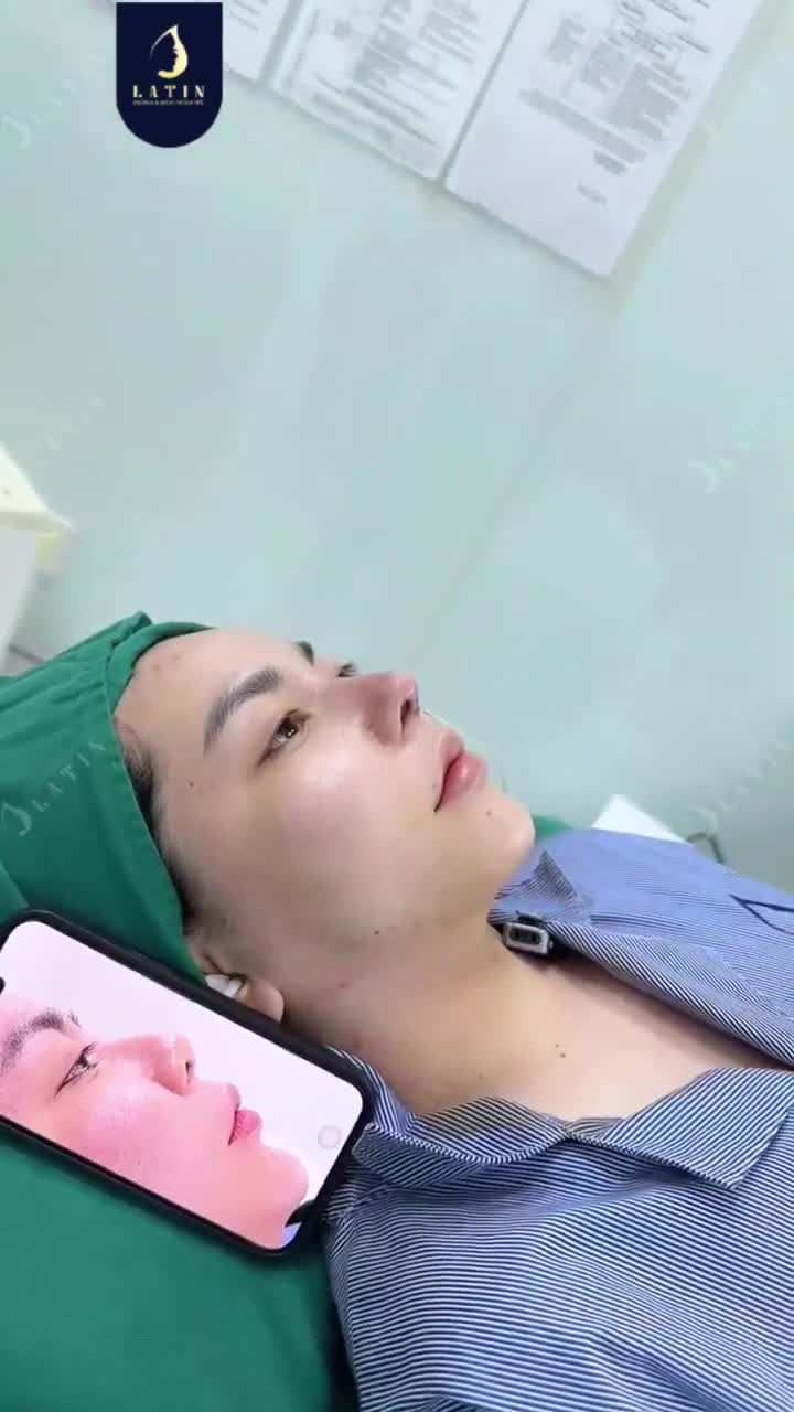 TRẢ KẾT QUẢ CA MŨI SỬA LẠI CẤU TRÚC SURGIFORM CHO KH TỪNG NÂNG MŨI CHỈ
