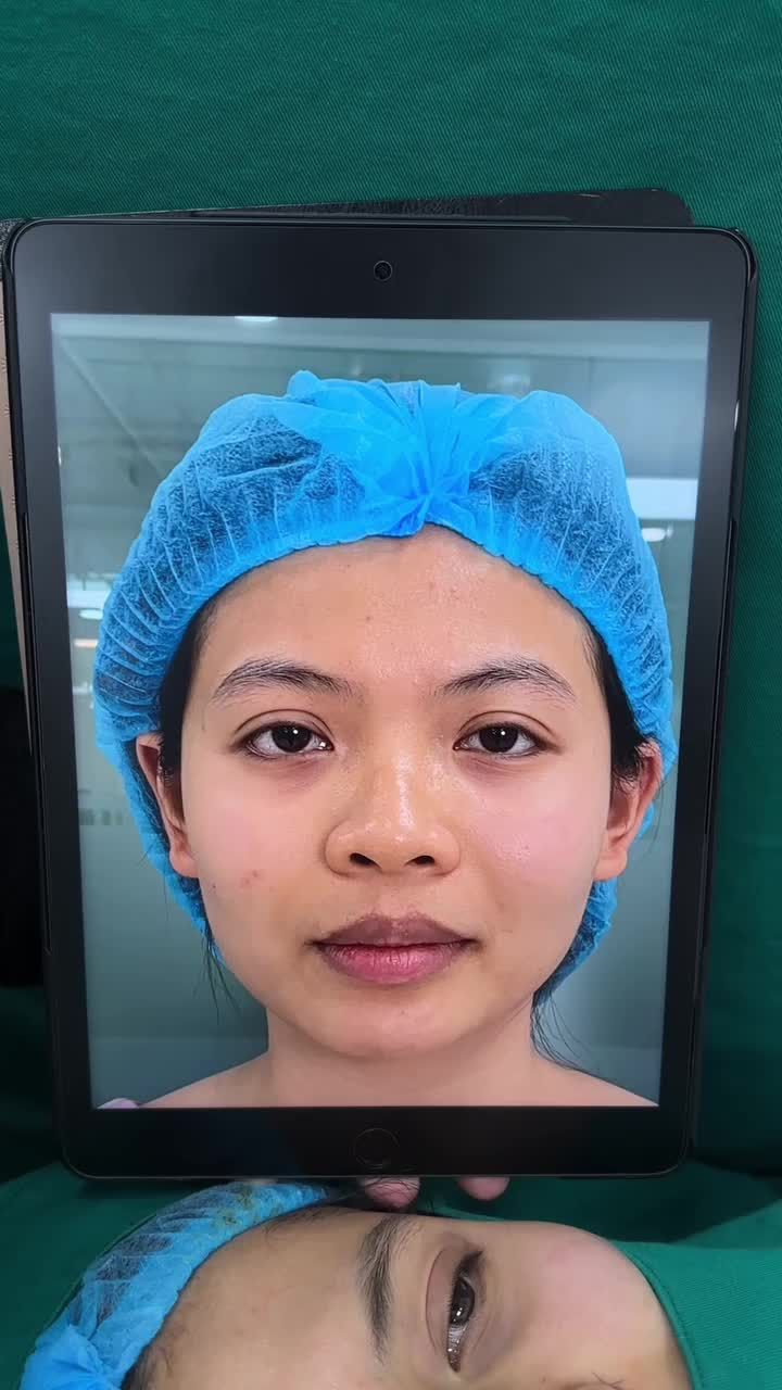 Trước khi làm em hồi hộp lắm, nhưng trộm vía làm xong như 2 người khác vậy!” – Phượng chia sẻ sau 45 phút nâng mũi cấu trúc kết hợp thu gọn cánh mũi.