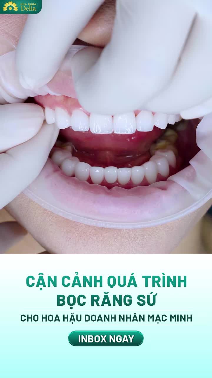 Chỉ sau 48 giờ để sở hữu 1 nụ cười tự tin, độc bản cho Hoa hậu doanh nhân quốc tế Mạc Minh