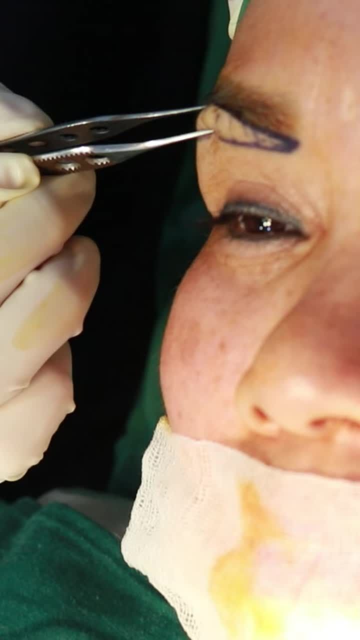 Mắt Trẻ TrungBạn sợ da chùng, sụp mí, và muốn cải thiện đường nét chân mày mà không để lại sẹo?