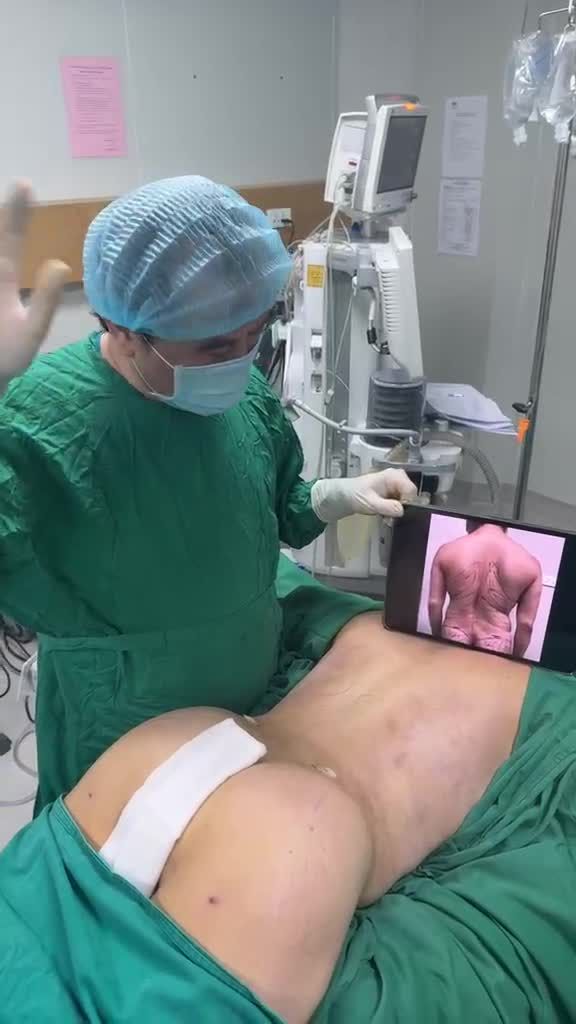 Tuyệt đại siêu kỹ thuật: HÚT MỠ LƯNG KO VẾT SẸO  - chỉ có với Dr Vương !