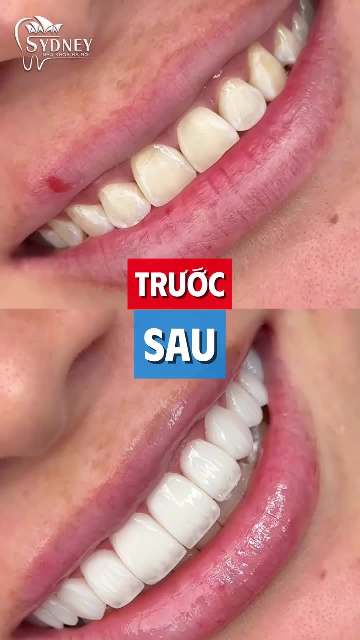 Sự khác nhau giữa dán sứ Veneer và bọc sứ