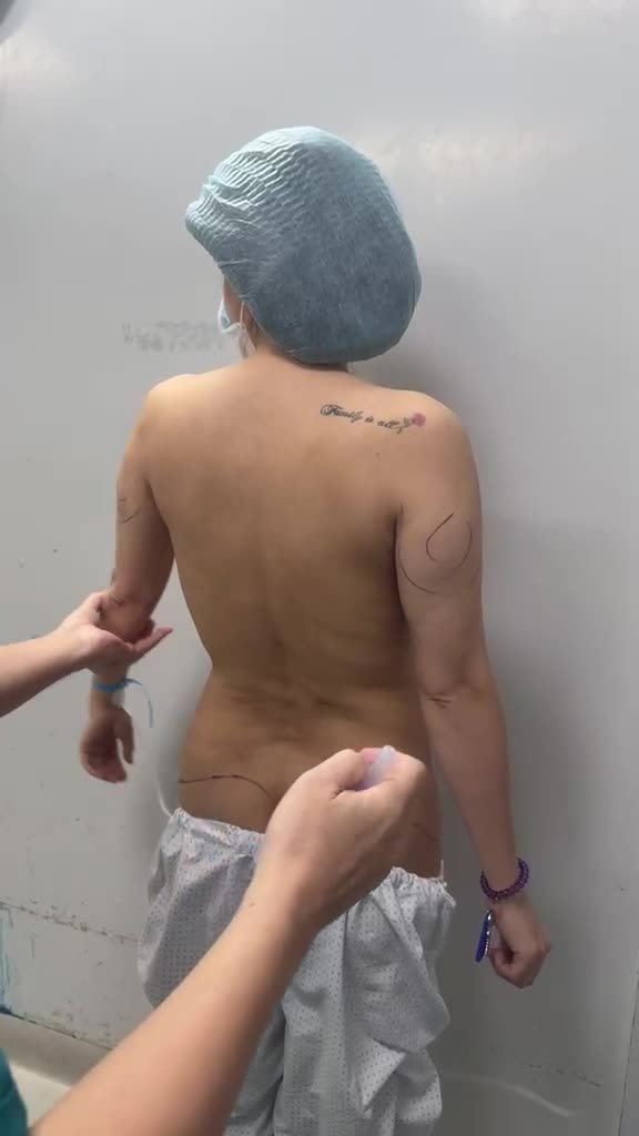 Thiết kế hút mỡ LƯNG ko sẹo (dấu sẹo ở vùng nách) với Dr Vương - Kỹ thuật hút mỡ lưng chuyên sâu chỉ có tại Dr Vương