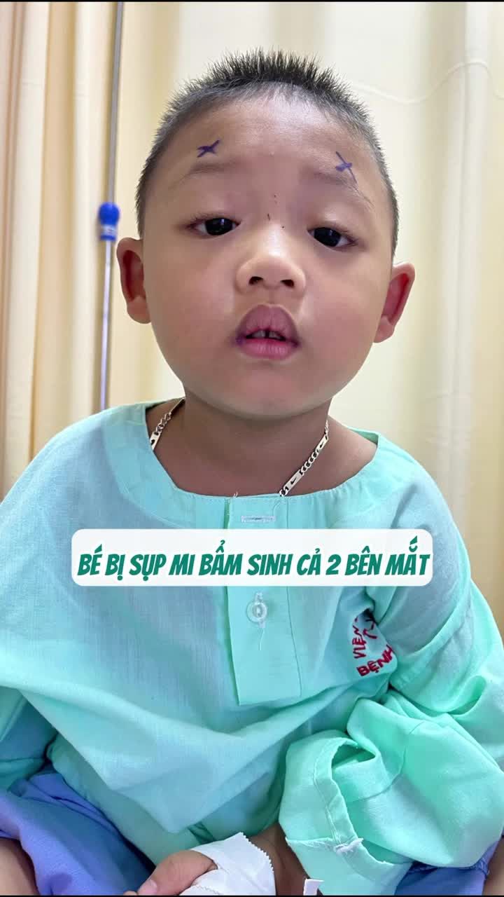 Sự Thay Đổi Sau Phẫu Thuật Sụp Mi Bẩm Sinh Của Bé Quang Thịnh