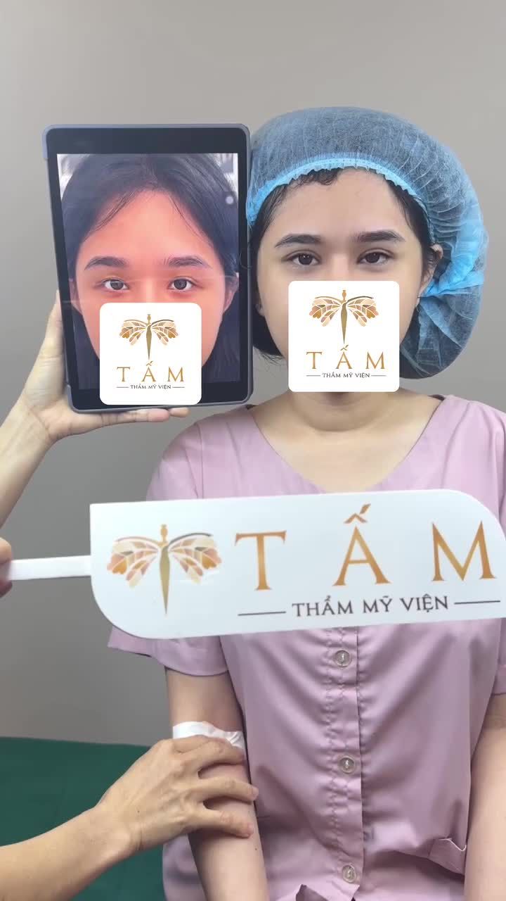 Có giải pháp nào giúp da mí hết chùng mà không làm mất nét riêng không? Câu trả lời là có