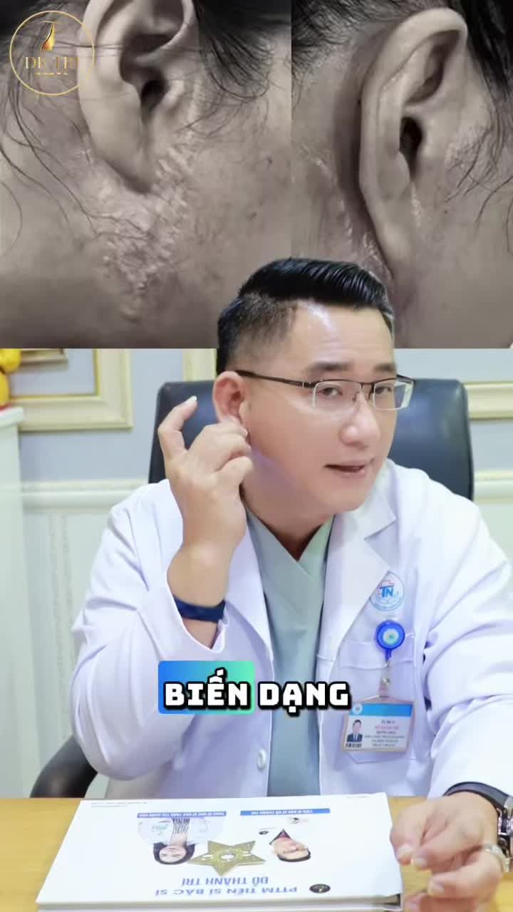 Căng da V_Line tại Dr Trí giúp tác động sâu đến lớp cơ nâng đỡ da, làm săn chắc toàn bộ cấu trúc gương mặt.