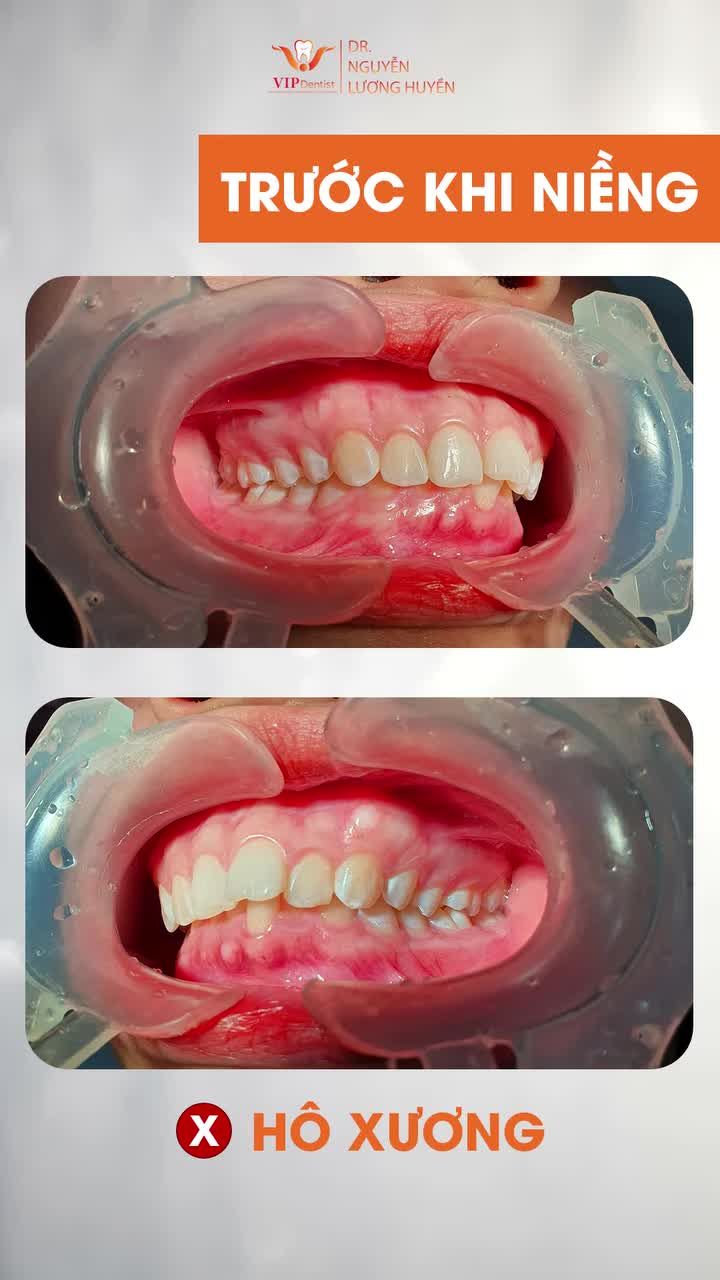 ới tình trạng răng khấp khểnh, hô xương nặng