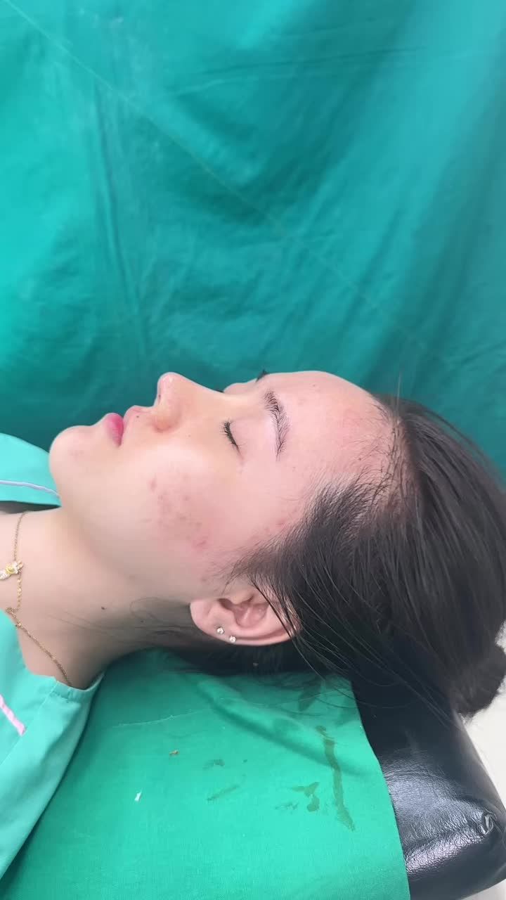 Mũi bọc sụn vừa hoàn thành