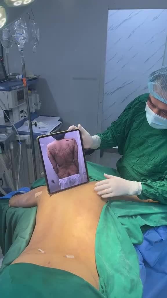 Hút mỡ lưng ko sẹo (dấu sẹo tít trên nếp nách) với Dr Vương