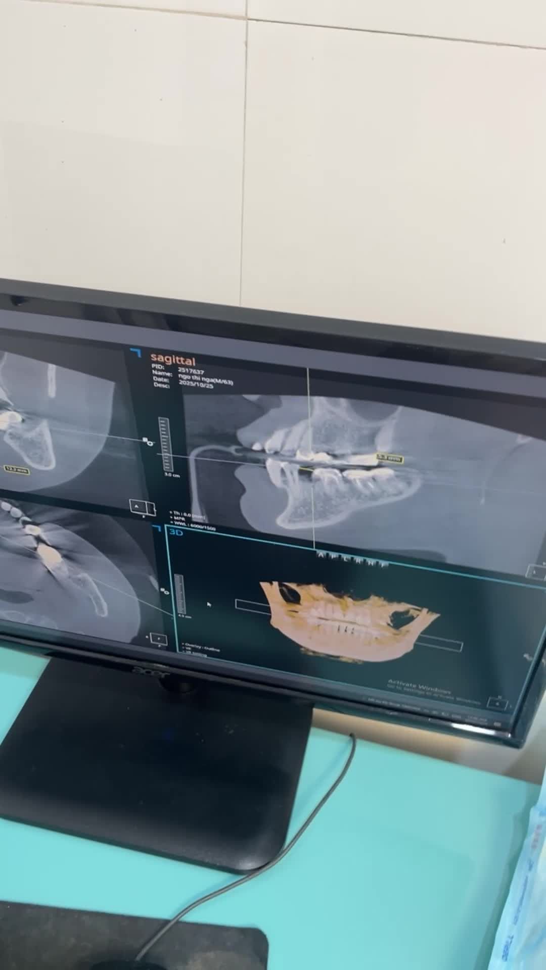 CẤY GHÉP IMPLANT TỨC THÌ – KHÔNG CHỜ ĐỢI, KHÔNG ĐAU, KHÔI PHỤC NỤ CƯỜI NGAY!