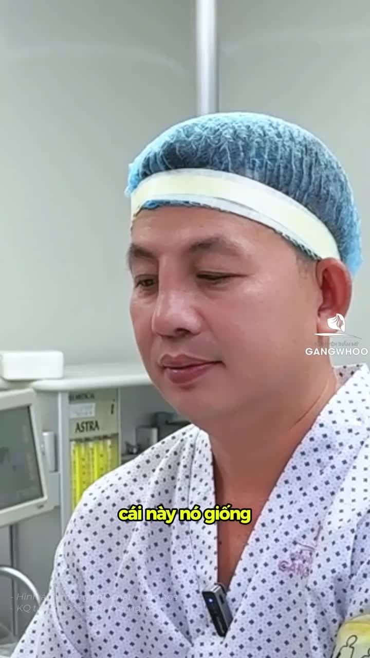 Sửa mũi lại cho ca mũi mọc từ trán
