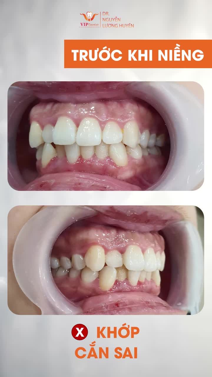 Hành trình NIỀNG RĂNG KHÔNG NHỔ RĂNG của nữ khách hàng tại VIP Dentist đã kết thúc !