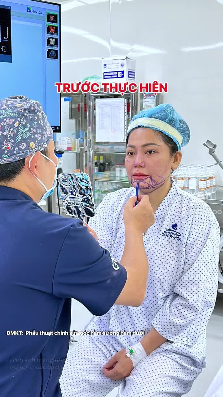 Sau 1 tuần thực hiện phẫu thuật chỉnh sửa góc hàm xương hàm dưới cho chị Thu Thuỷ - doanh nhân