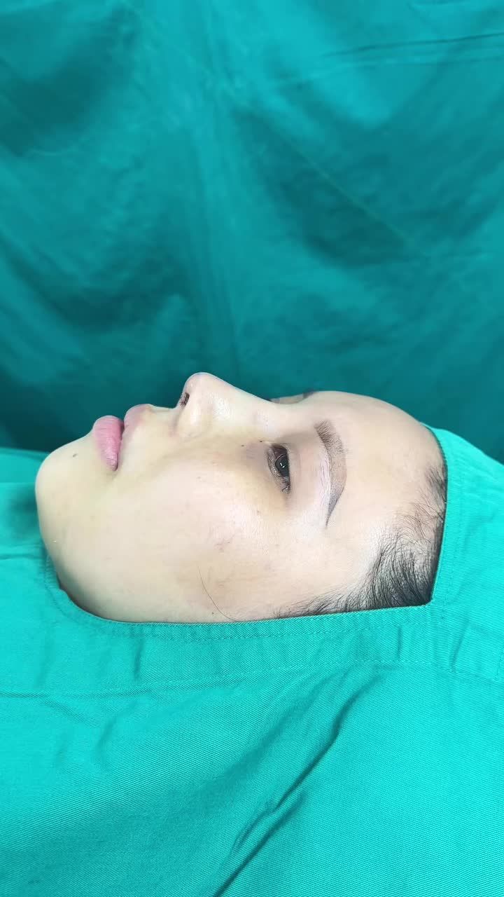Mũi cấu trúc surgiform vừa hoàn thành