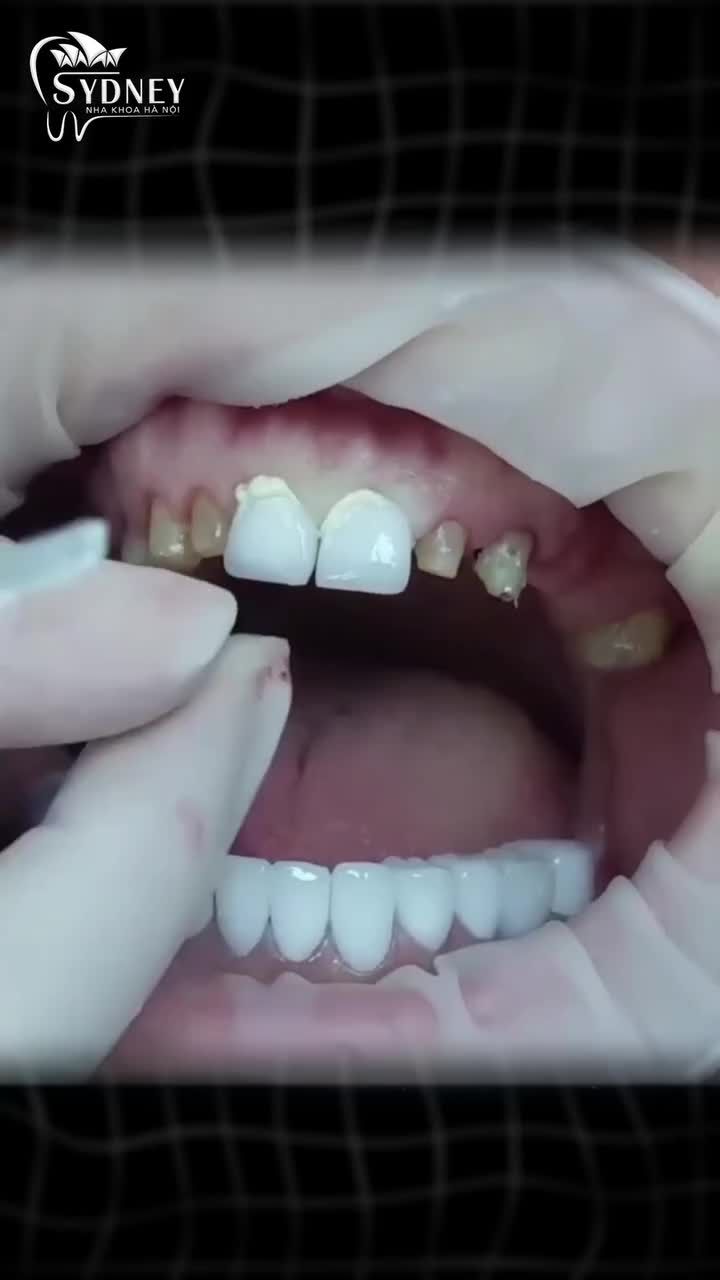 Top 4 dòng răng toàn sứ cao cấp