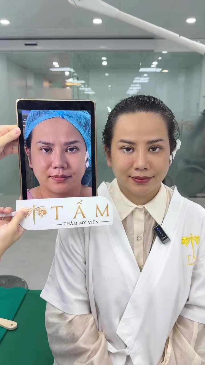 Đã từng Mở Góc Mắt tại Phòng khám, vì rất tin tưởng tay nghề bác sĩ nên lần này chị lựa chọn Phòng khám để sửa lại đôi mắt hơi dữ và mũi bị lệch, vẹo.