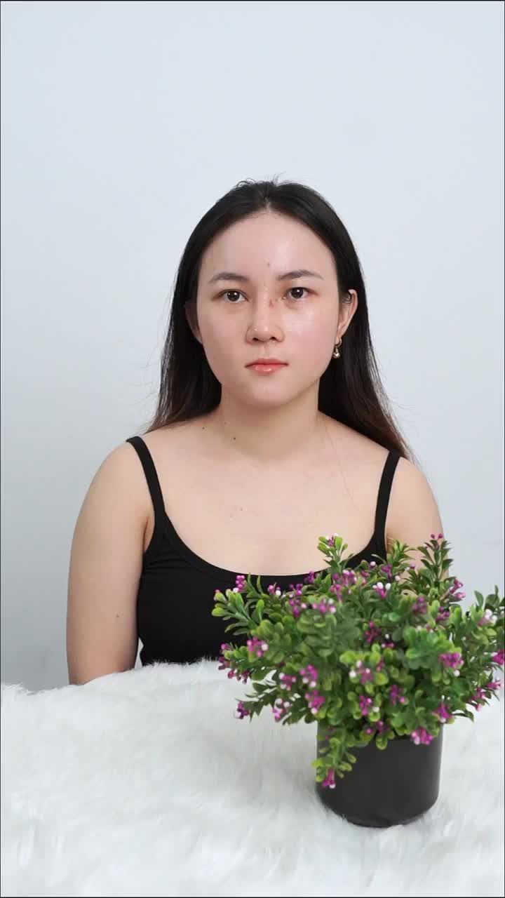 KẾT QUẢ NÂNG MŨI CẤU TRÚC SAU 10 NGÀY CỦA EM GÁI "OVERTHINKING"