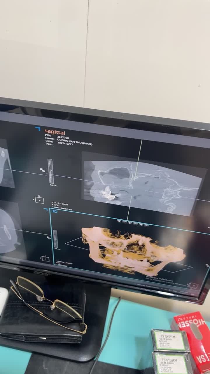 ca cấy Implant tại cơ sở Thái Hà