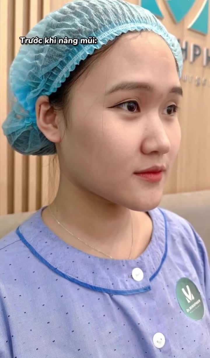 Trước đây: Ngại chụp nghiêng vì dáng mũi thấp.  Sau khi nâng mũi tại Dr. Minh Phạm:  Sống mũi cao tự nhiên, chuẩn tỉ lệ khuôn mặt  Không lộ sụn, không bóng đỏ  Ai gặp cũng khen