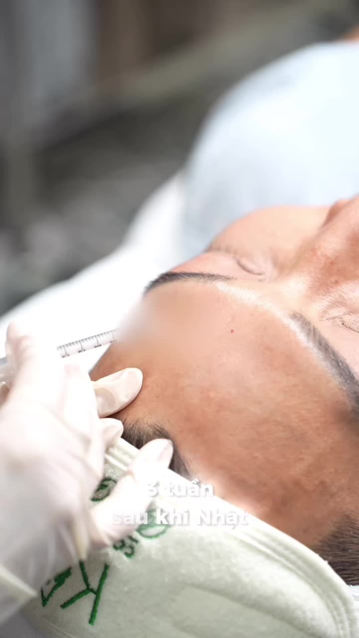 Không cần filter – da anh Bình sau liệu trình tiêm Meso thật sự khác biệt