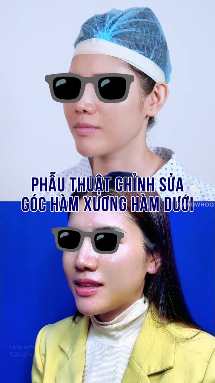 Chị khách hàng chia sẻ, góc hàm trước đây hơi thô, to và không hài hòa với gương mặt, vì vậy chị quyết định thực hiện gọt hàm để gương mặt thanh tú hơn.