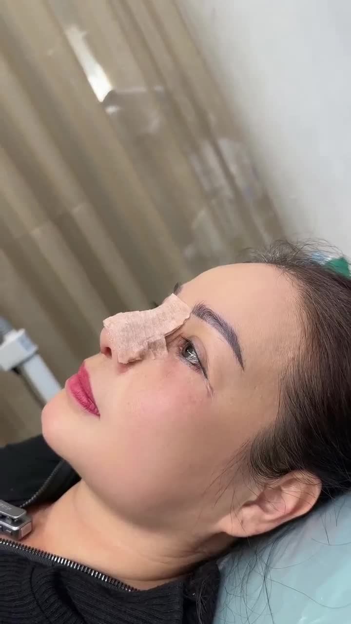 KHOE MŨI ĐẸP NGAY KHI THÁO NẸP!