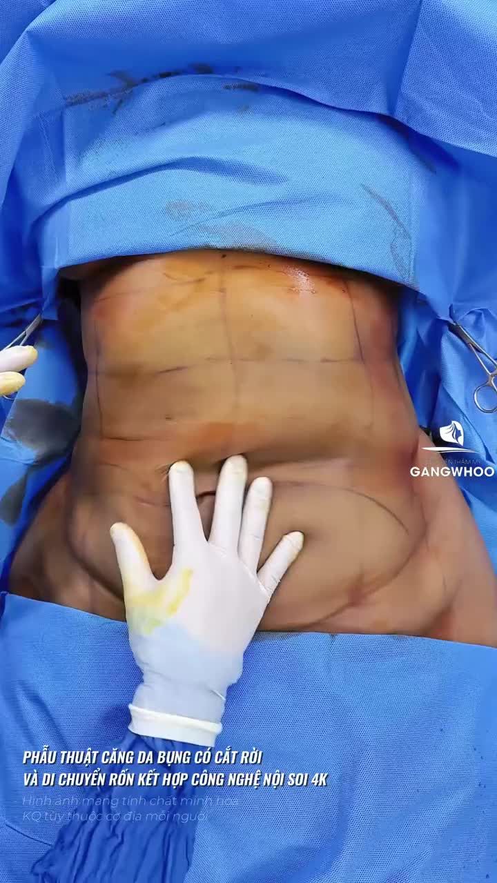 Kết quả sau 90 phút phẫu thuật căng da bụng có kết hợp và di chuyển rốn của khách hàng Úc - 49 tuổi.