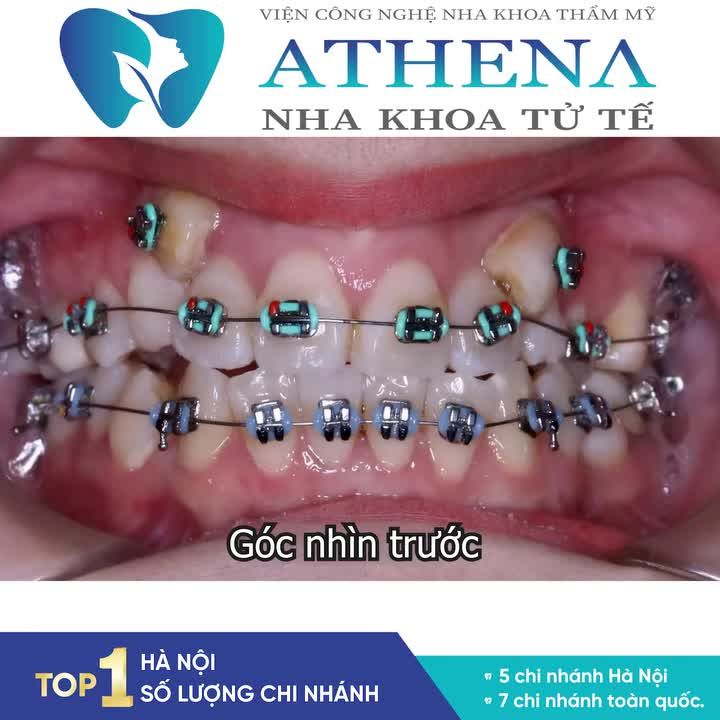 NIỀNG RĂNG THẦN KỲ NHƯ THẾ NÀO?