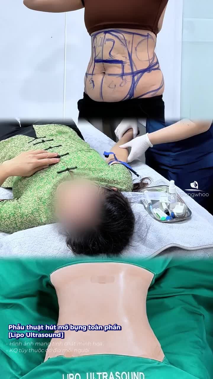 Vòng eo sồ sề sau sinh 3 bé, chị khách đến Gangwhoo trải nghiệm phẫu thuật hút mỡ bụng toàn phần nhẹ nhàng, không đau