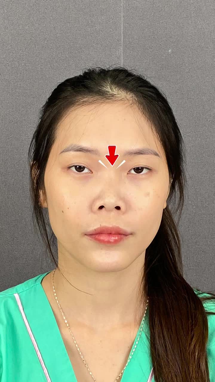 NÂNG MŨI - ĐẸP HÀI HÒA, KHẮC PHỤC LUÔN TÌNH TRẠNG ''HÔ MÓM''!!