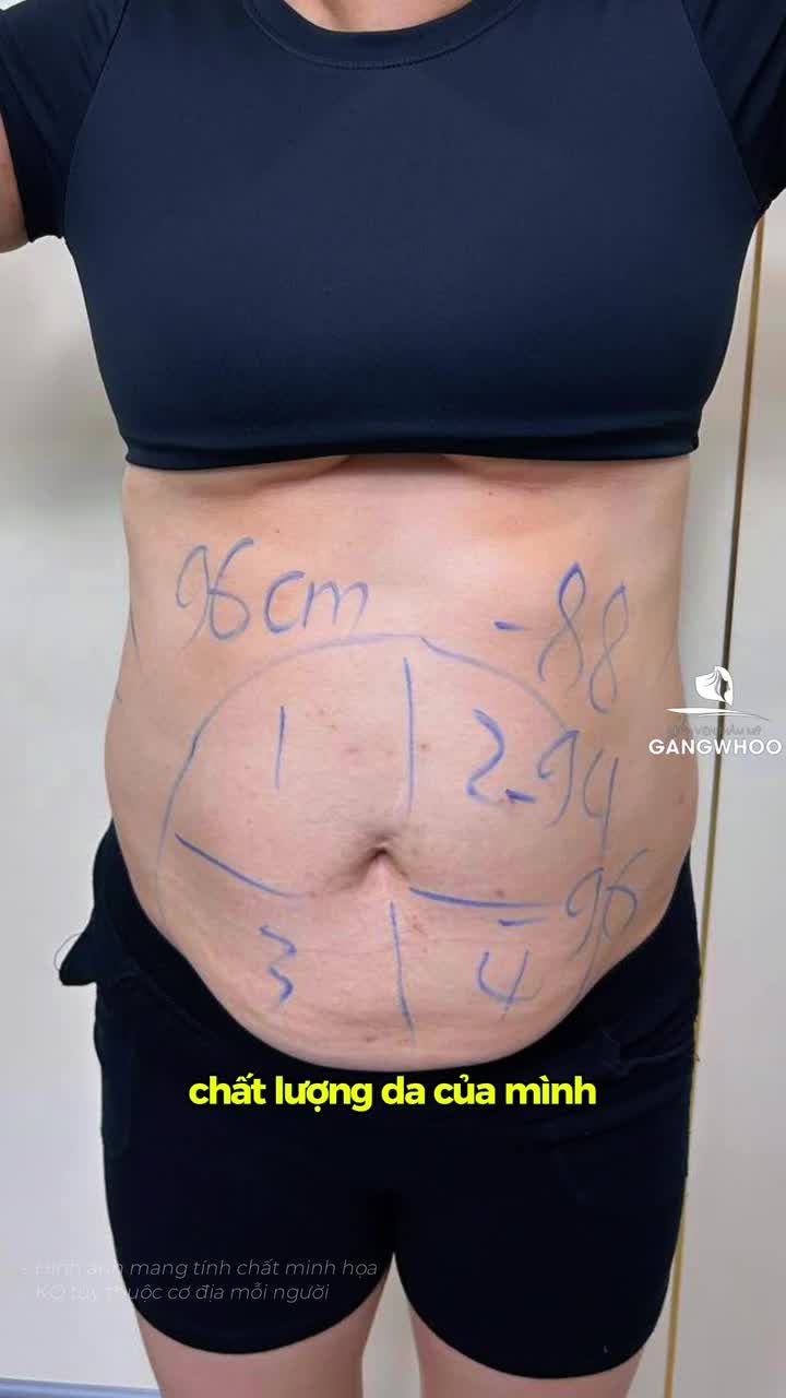 60 phút phẫu thuật hút mỡ bụng toàn phần loại bỏ mỡ thừa lâu năm nhẹ nhàng, chị khách có những chia sẻ chân thật ngay sau thực hiện