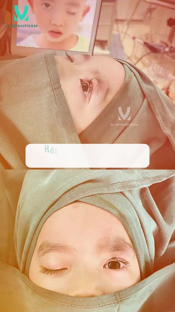 Trường hợp của bé Thế An: Sụp mí bẩm sinh mắt trái nặng, khiến hai bên mắt mở không đều, ảnh hưởng thẩm mỹ và tầm nhìn