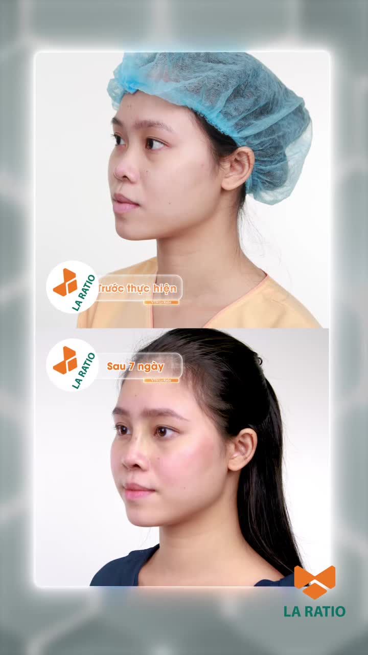 7 ngày – đủ để thấy dáng mũi nhẹ nhàng vào Form