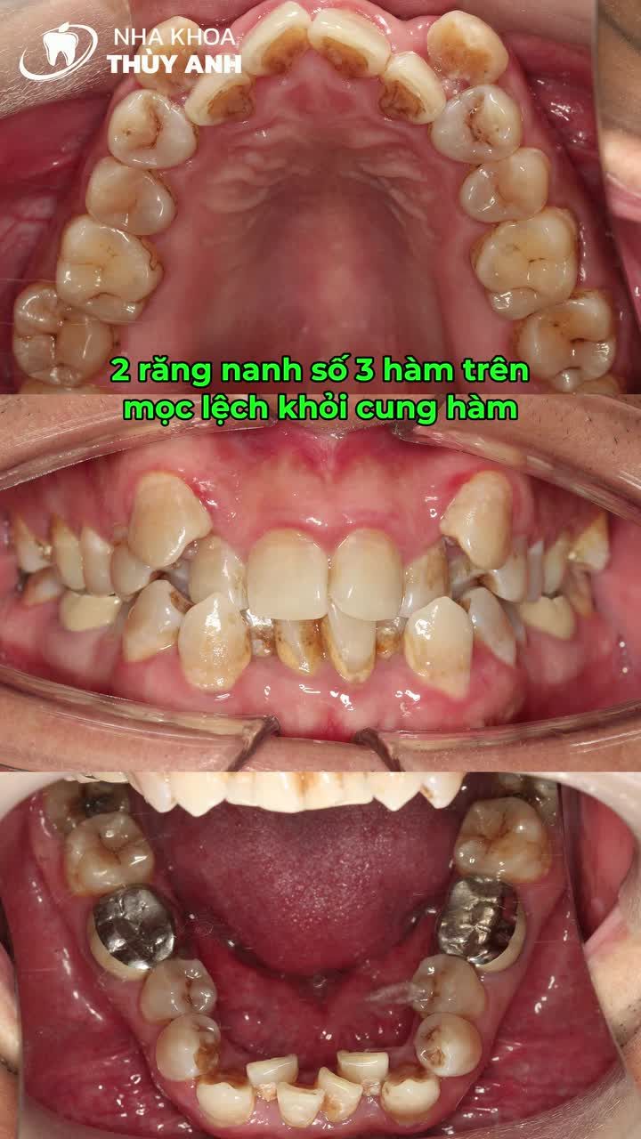 40 TUỔI VẪN CÓ THỂ NIỀNG RĂNG HIỆU QUẢ VỚI INVISALIGN