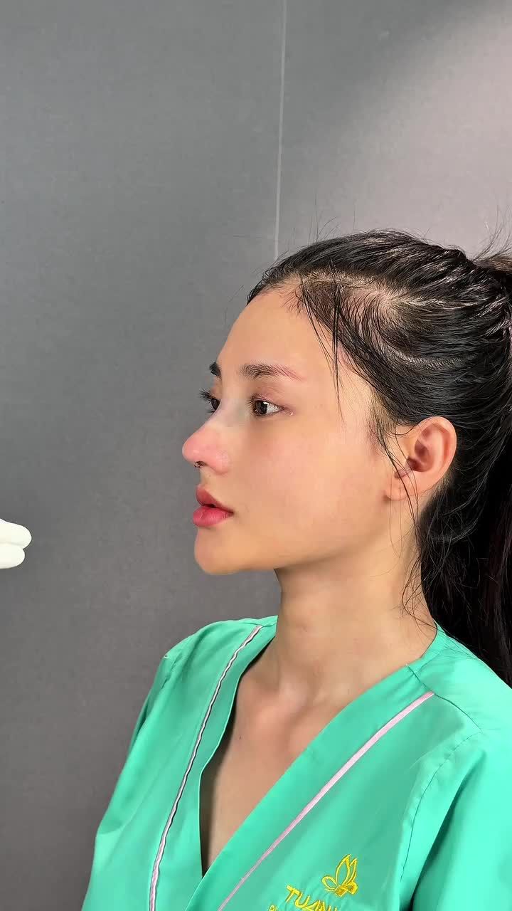 Mũi nhỏ, không có sóng mũi thì nên chọn phương pháp nào và sẽ thay đổi ra sao??