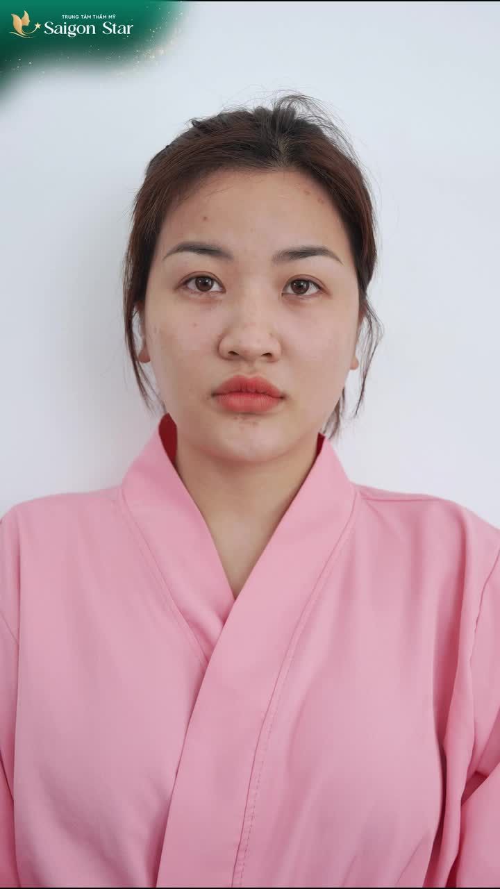 DÁNG MŨI TỰ NHIÊN - AN TOÀN CHO EM GÁI 2K2