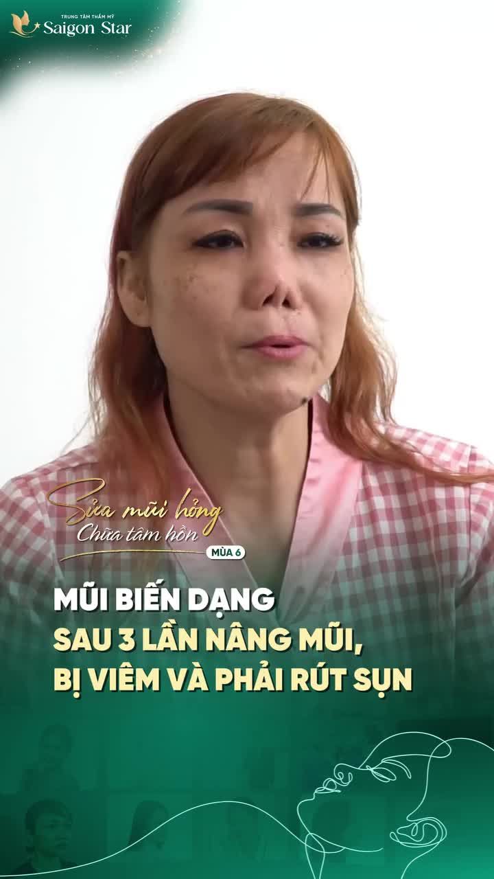 BÁC SĨ HOẠT NỖ LỰC GIẢI CỨU DÁNG MŨI BIẾN DẠNG NẶNG SAU 3 LẦN NÂNG MŨI HỎNG
