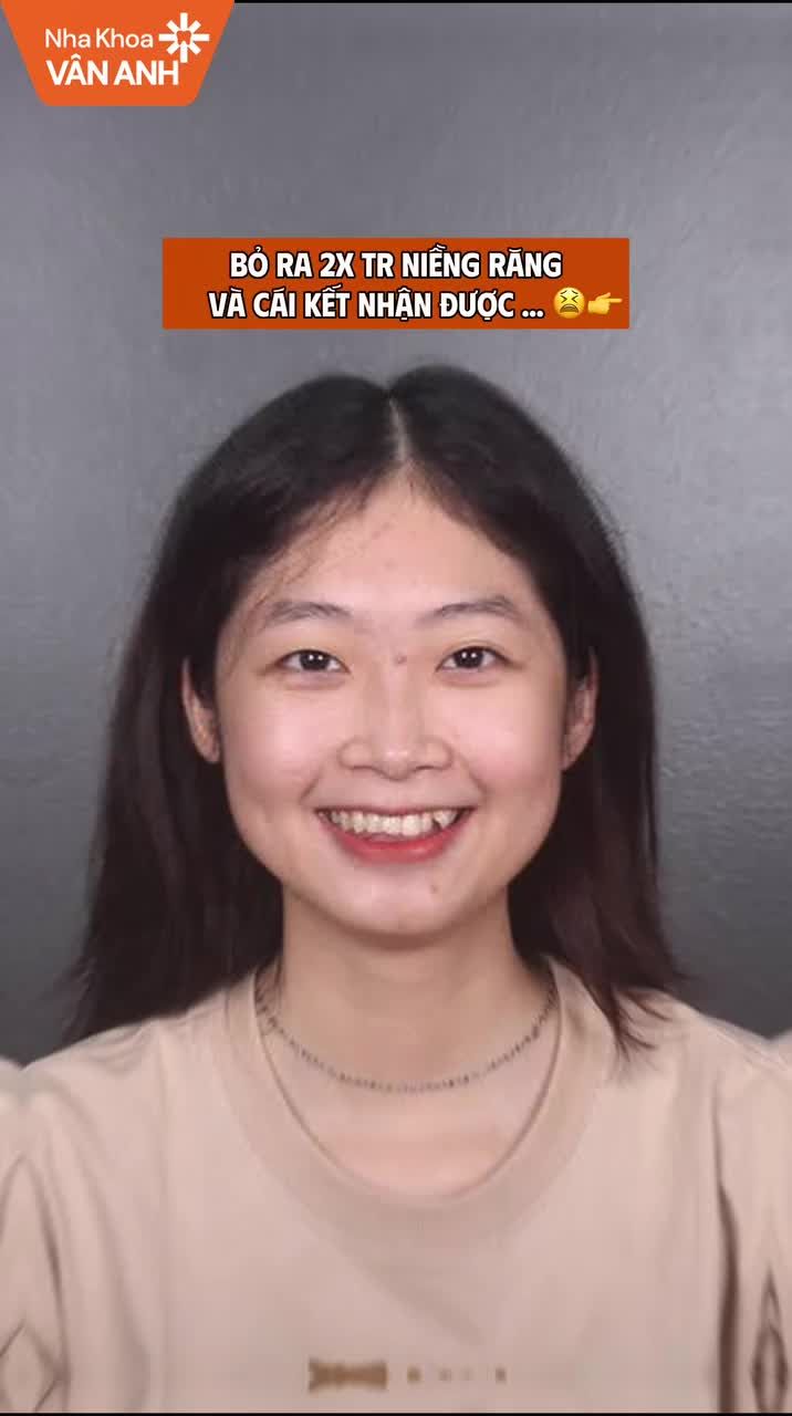 Bỏ ra 2X triệu niềng răng và cái kết nhận được.