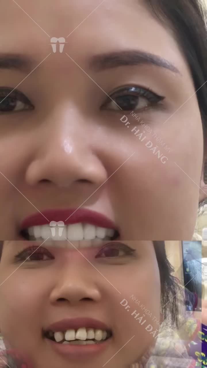 Răng khấp khểnh, hô.. biến hình sau 24 giờ thay đổi ngoạn mục được mô tả bằng video dưới đây