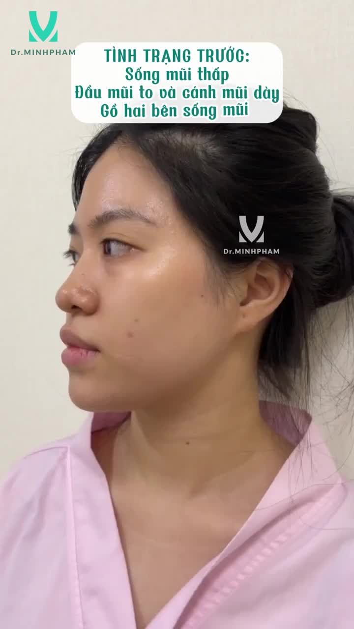 Nâng mũi đã thay đổi nhan sắc của khách hàng như thế nào