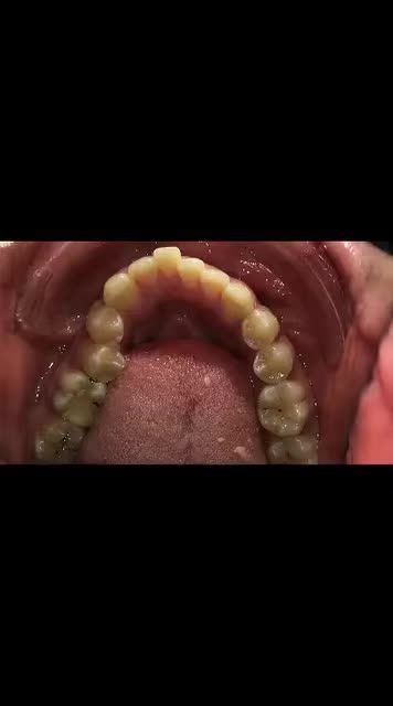 Chuyển động của niềng răng braces volution