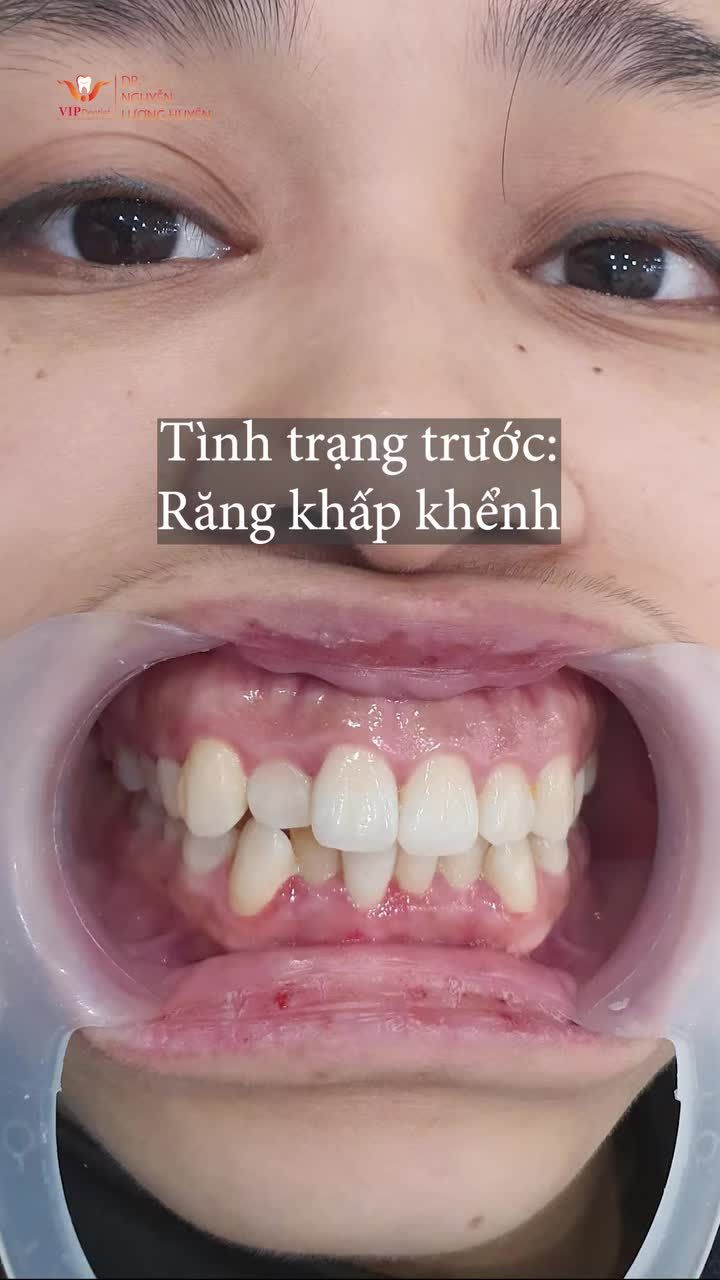 “Tháo niềng xong bây giờ em cảm thấy x2, x3 sự tự tin luôn ấy. Em cười đẹp hơn, mặt em cũng cân đối hài hoà hơn” - Bạn Thanh Dung chia sẻ.