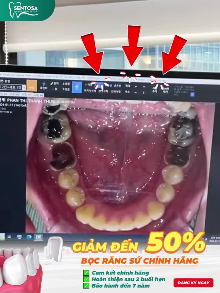 CHỈ CÒN NỬA GIÁ – KHẮC PHỤC CÁC VẤN ĐỀ RĂNG CHỈ SAU 2 BUỔI HẸN