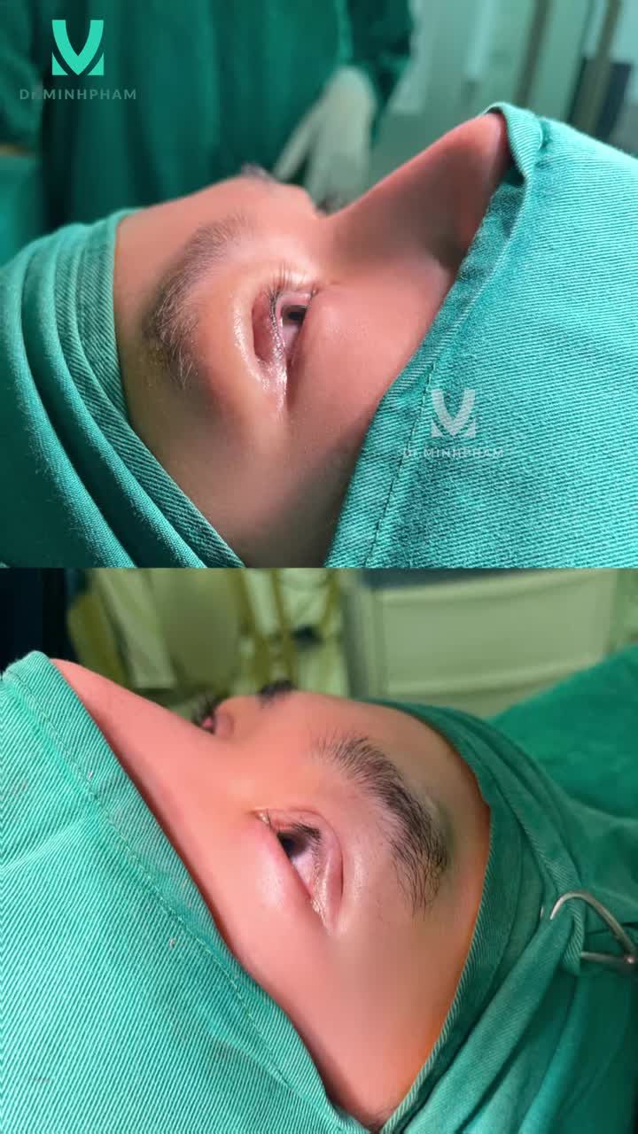 Sau 2 tháng cùng Dr. Minh Phạm tìm lại đôi mắt đẹp sẽ như thế nào?