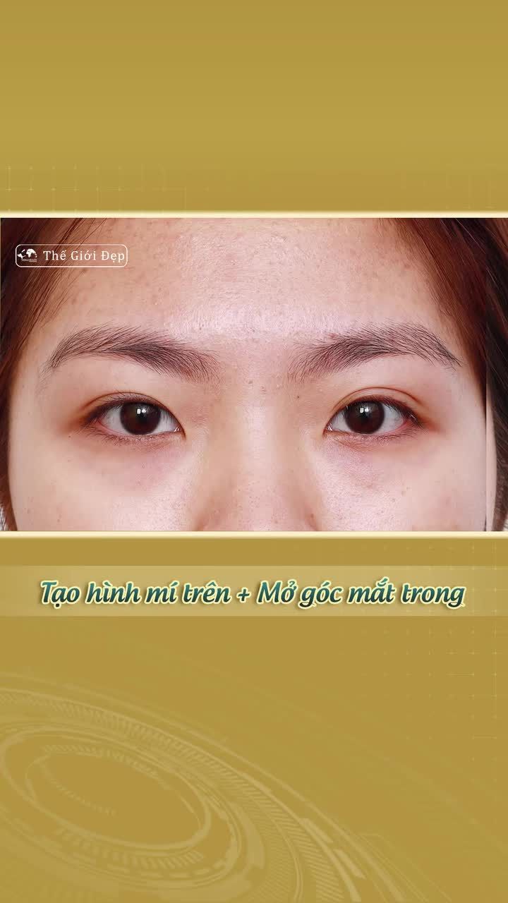 Tạo hình mí trên + Mở góc mắt trong - Giải pháp cho đôi mắt cân đối và sáng rõ hơn