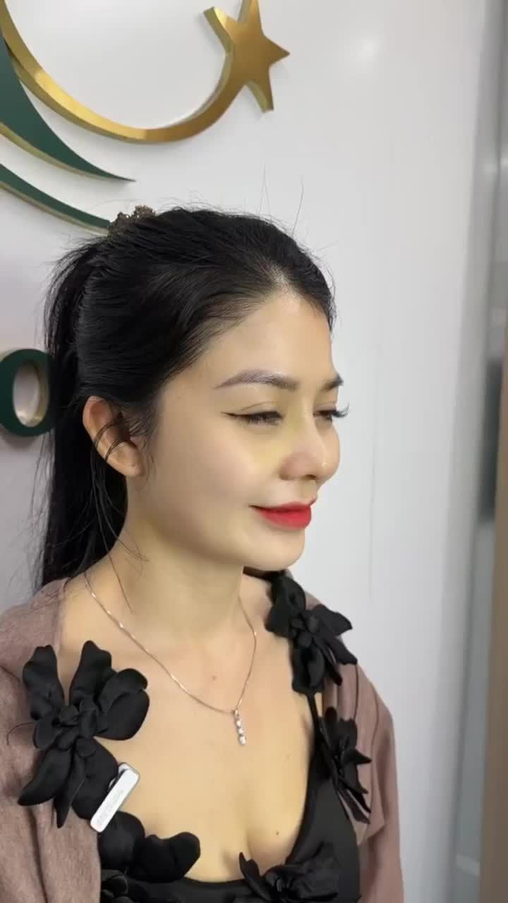 CHỊ KHÁCH SIÊU HÀI LÒNG SAU 10 NGÀY NÂNG MŨI TẠI BÁC SĨ HOẠT